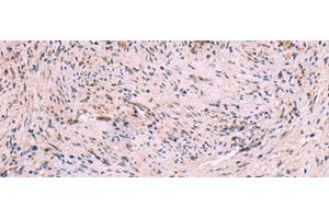 Immunohistochemistry of paraffin-embedded Human cervical cancer tissue using MBTPS2 Polyclonal Antibody at dilution of 1:30(x200) (MBTPS2 antibody)