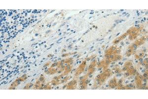 Immunohistochemistry of paraffin-embedded Human liver cancer using NDRG2 Polyclonal Antibody at dilution of 1:50 (NDRG2 antibody)
