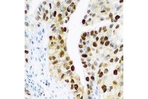 Immunohistochemical analysis of PHC1 staining in human prostate formalin fixed paraffin embedded tissue section. (PHC1 antibody)
