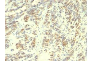 Formalin-fixed, paraffin-embedded human Leiomyosarcoma stained with Transglutaminase II Mouse Monoclonal Antibody (SPM358). (Transglutaminase 2 antibody)
