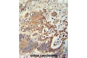 CHCHD2 antibody (Center) immunohistochemistry analysis in formalin fixed and paraffin embedded human colon carcinoma followed by peroxidase conjugation of the secondary antibody and DAB staining. (CHCHD2 antibody  (Middle Region))