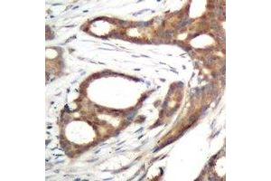 Immunohistochemical analysis of PER2 (pS662) staining in human prostate cancer formalin fixed paraffin embedded tissue section. (PER2 antibody  (pSer662))