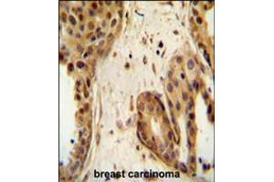 STAT2 Antibody immunohistochemistry analysis in formalin fixed and paraffin embedded human breast carcinoma followed by peroxidase conjugation of the secondary antibody and DAB staining. (STAT2 antibody  (C-Term))