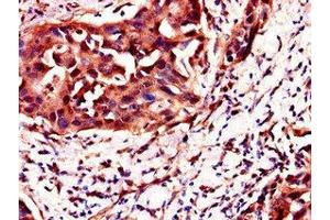 Immunohistochemistry of paraffin-embedded human bladder cancer using ABIN7162131 at dilution of 1:100 (Uncharacterized Protein C4orf26 (ODAPH) (AA 24-130) antibody)