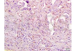 Formalin-fixed and paraffin embedded human ovarian carcinoma labeled with Anti-Aurora A/ARK-1/AURKA Polyclonal Antibody, Unconjugated (ABIN750053) at 1:200 followed by conjugation to the secondary antibody and DAB staining. (Aurora A antibody)