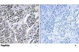 Immunohistochemistry analysis of paraffin-embedded human lung carcinoma tissue using ATP5D polyclonal antibody . (ATP5F1D antibody)