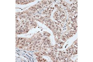 Immunohistochemistry of paraffin-embedded human endometrium cancer using RBM17 antibody (ABIN6133103, ABIN6146765, ABIN6146766 and ABIN6220171) at dilution of 1:100 (40x lens). (RBM17 antibody  (AA 1-240))