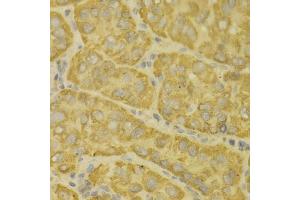 Immunohistochemistry of paraffin-embedded human liver cancer using MAOA antibody (ABIN5970633) at dilution of 1/100 (40x lens). (Monoamine Oxidase A antibody)