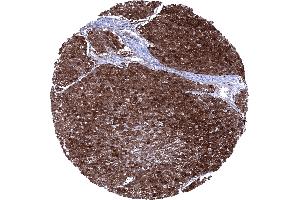 Squamous cell carcinoma of the esophagus showing a Cystatin A immunostaining of all tumor cells (CSTA antibody)