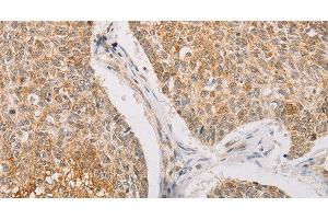Immunohistochemistry of paraffin-embedded Human lung cancer tissue using STK40 Polyclonal Antibody at dilution 1:40 (STK40 antibody)