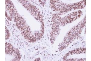 IHC-P Image Immunohistochemical analysis of paraffin-embedded human colon carcinoma, using Lamin B1 antibody, antibody at 1:250 dilution.