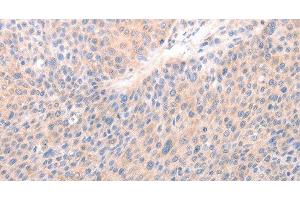Immunohistochemistry of paraffin-embedded Human liver cancer tissue using ACO1 Polyclonal Antibody at dilution 1:50 (Aconitase 1 antibody)
