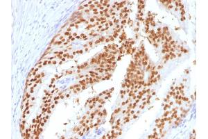Formalin-fixed, paraffin-embedded human Prostate (PIN) stained with FOXA1 Mouse Monoclonal Antibody (FOXA1/1516). (FOXA1 antibody  (AA 372-472))