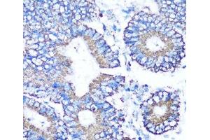 Immunohistochemistry of paraffin-embedded Human colon carcinoma using MMP16 Polyclonal Antibody at dilution of 1:100 (40x lens). (MMP16 antibody)