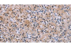Immunohistochemistry of paraffin-embedded Human prostate cancer using SLC1A6 Polyclonal Antibody at dilution of 1:40