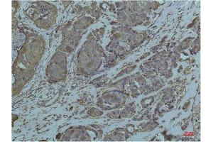 Immunohistochemistry (IHC) analysis of paraffin-embedded Human Breast Carcicnoma using GRP78/Bip Mouse Monoclonal Antibody diluted at 1:200. (GRP78 antibody)