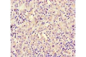 Immunohistochemistry of paraffin-embedded human lung cancer using ABIN7167721 at dilution of 1:100 (CoREST antibody  (AA 394-482))