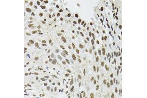 Immunohistochemistry of paraffin-embedded human lung cancer using SFPQ antibody (ABIN5970351) at dilution of 1/100 (40x lens). (SFPQ antibody)
