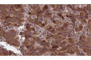 ABIN6277317 at 1/100 staining Human liver cancer tissue by IHC-P. (CNTF Receptor alpha antibody  (Internal Region))
