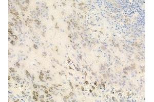 ABIN6262527 and ABIN6278482 at 1/100 staining human melanoma by IHC-P. (IL32 antibody  (Internal Region))
