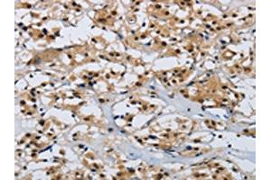 The image on the left is immunohistochemistry of paraffin-embedded Human thyroid cancer tissue using ABIN7190315(CMTM8 Antibody) at dilution 1/40, on the right is treated with synthetic peptide. (CMTM8 antibody)