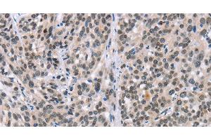 Immunohistochemistry of paraffin-embedded Human esophagus cancer tissue using ADNP Polyclonal Antibody at dilution 1:50 (ADNP antibody)