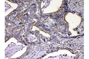 IHC testing of FFPE human intestinal cancer tissue with CCN3 antibody at 1ug/ml.