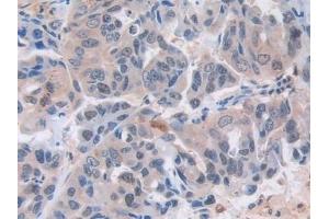 Detection of MX1 in Human Breast cancer Tissue using Polyclonal Antibody to Myxovirus Resistance 1 (MX1) (MX1 antibody  (AA 80-342))