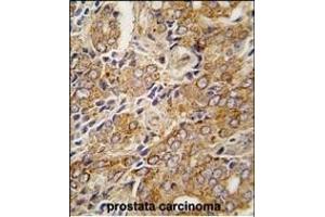 Formalin-fixed and paraffin-embedded human prostata carcinoma tissue reacted with TR antibody (C-term ) (ABIN392821 and ABIN2842253) , which was peroxidase-conjugated to the secondary antibody, followed by DAB staining. (TRPM8 antibody  (C-Term))