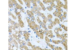 Immunohistochemistry of paraffin-embedded Human liver damage using TOB2 Polyclonal Antibody at dilution of 1:100 (40x lens). (TOB2 antibody)