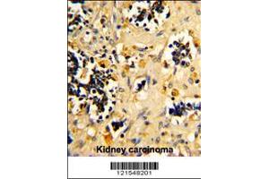 Formalin-fixed and paraffin-embedded human kidney carcinoma reacted with NDUFS4 Antibody , which was peroxidase-conjugated to the secondary antibody, followed by DAB staining. (NDUFS4 antibody  (C-Term))