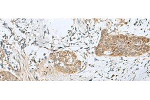 Immunohistochemistry of paraffin-embedded Human esophagus cancer tissue using SNRPD1 Polyclonal Antibody at dilution of 1:70(x200) (SNRPD1 antibody)