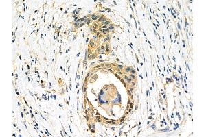 ABIN6263253 and ABIN6276669 at 1/100 staining Human esophageal cancer by IHC-P.