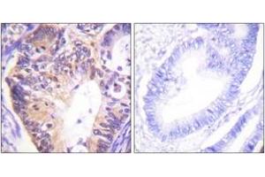 Immunohistochemistry analysis of paraffin-embedded human colon carcinoma tissue, using PAK1 (Ab-212) Antibody. (PAK1 antibody  (AA 178-227))