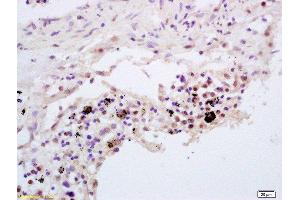 Formalin-fixed and paraffin embedded human lung carcinoma labeled with Rabbit Anti TNFAIP3/A20 Polyclonal Antibody, Unconjugated  at 1:200 followed by conjugation to the secondary antibody and DAB staining (TNFAIP3 antibody  (AA 51-150))