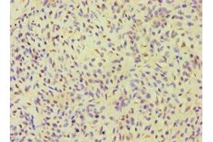 Immunohistochemistry of paraffin-embedded human breast cancer using ABIN7155980 at dilution of 1:100 (ALOXE3 antibody  (AA 1-280))