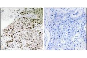 Immunohistochemistry analysis of paraffin-embedded human breast carcinoma tissue, using TAF13 Antibody. (TAF13 antibody  (AA 71-120))