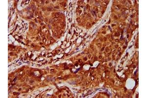IHC image of ABIN7151572 diluted at 1:600 and staining in paraffin-embedded human cervical cancer performed on a Leica BondTM system. (IKAP/p150 antibody  (AA 1107-1258))