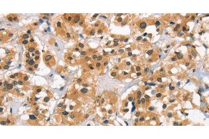 Immunohistochemistry of paraffin-embedded Human thyroid cancer tissue using Cav1. (CACNA1C antibody)