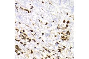Immunohistochemistry of paraffin-embedded human kidney cancer using SUMO4 Antibody (ABIN5971586) at dilution of 1/200 (40x lens). (SUMO4 antibody)