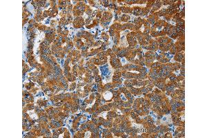 Immunohistochemistry of Human liver cancer using FLCN Polyclonal Antibody at dilution of 1:40