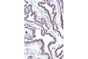 Immunohistochemical staining (Formalin-fixed paraffin-embedded sections) of human ovarian cancer (A, B) with FBXO5 monoclonal antibody, clone EMI1/1176 . (FBXO5 antibody  (AA 1-250))