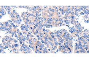 Immunohistochemistry of paraffin-embedded Human ovarian cancer tissue using KCNH8 Polyclonal Antibody at dilution 1:50