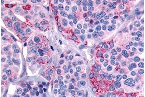 Human Thyroid, Medullary Carcinoma (formalin-fixed, paraffin-embedded) stained with CALCR antibody ABIN213557 at 20 ug/ml followed by biotinylated goat anti-rabbit IgG secondary antibody ABIN481713, alkaline phosphatase-streptavidin and chromogen. (Calcitonin Receptor antibody  (C-Term))