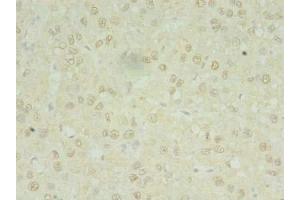 Immunohistochemistry of paraffin-embedded human liver cancer using ABIN7142391 at dilution of 1:100 (MRPL3 antibody  (AA 201-348))