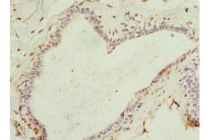 Immunohistochemistry of paraffin-embedded human breast cancer using ABIN7167073 at dilution of 1:100 (HBXIP antibody  (AA 1-91))