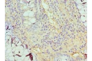 Immunohistochemistry of paraffin-embedded human colon cancer using ABIN7153379 at dilution of 1:100 (TDG antibody  (AA 141-410))