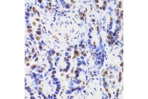 Immunohistochemistry of paraffin-embedded human lung cancer using HDGF Antibody.