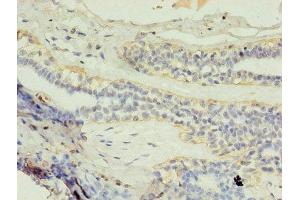 Immunohistochemistry of paraffin-embedded human breast cancer using ABIN7154147 at dilution of 1:100 (GK2 antibody  (AA 2-553))