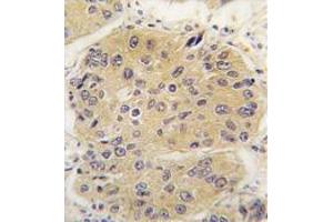 Formalin-Fixed, Paraffin-Eembedded Human lung carcinoma tissue stained with EIF4A1 Antibody (N-term),which was peroxidase-conjugated to the secondary antibody, followed by DAB staining. (EIF4A1 antibody  (N-Term))
